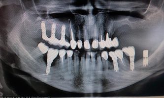 Progressive Peri-Implantid around all conventional dental imlant except in region 38.