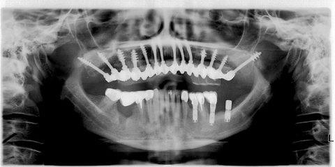 With in days after the removal of the affected implants a new bridge in ther lower jaw was incorporated (44 – 47), and the upper jaw was restored with 14 corticobasal implants in an immediate functional loading protocol.